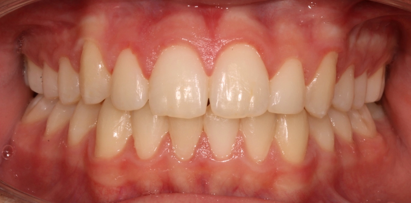 Orthodontics after treatment