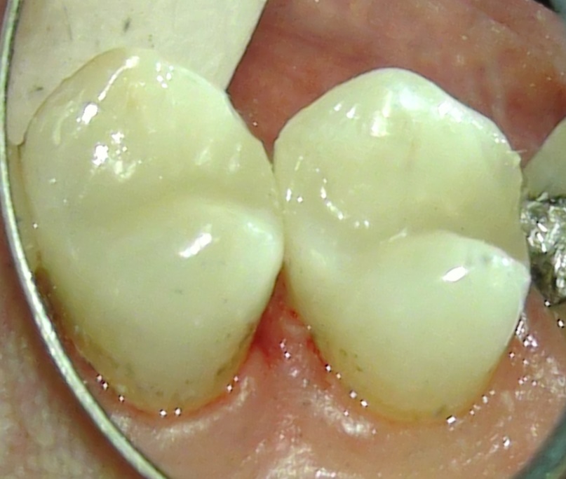 2 teeth after they have been protected with a same day, porcelain Cerec crown