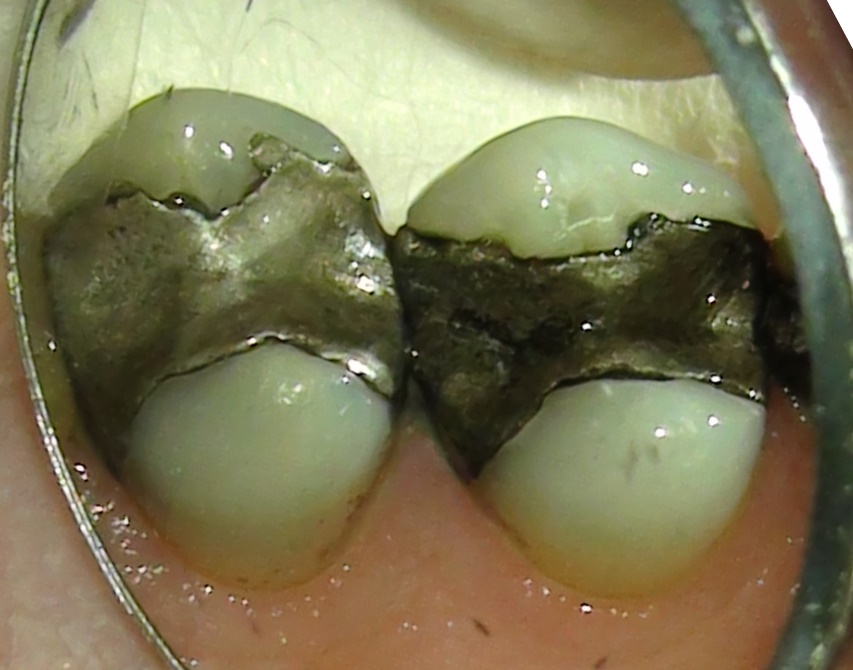 2 teeth before being protected with a porcelain same day crown