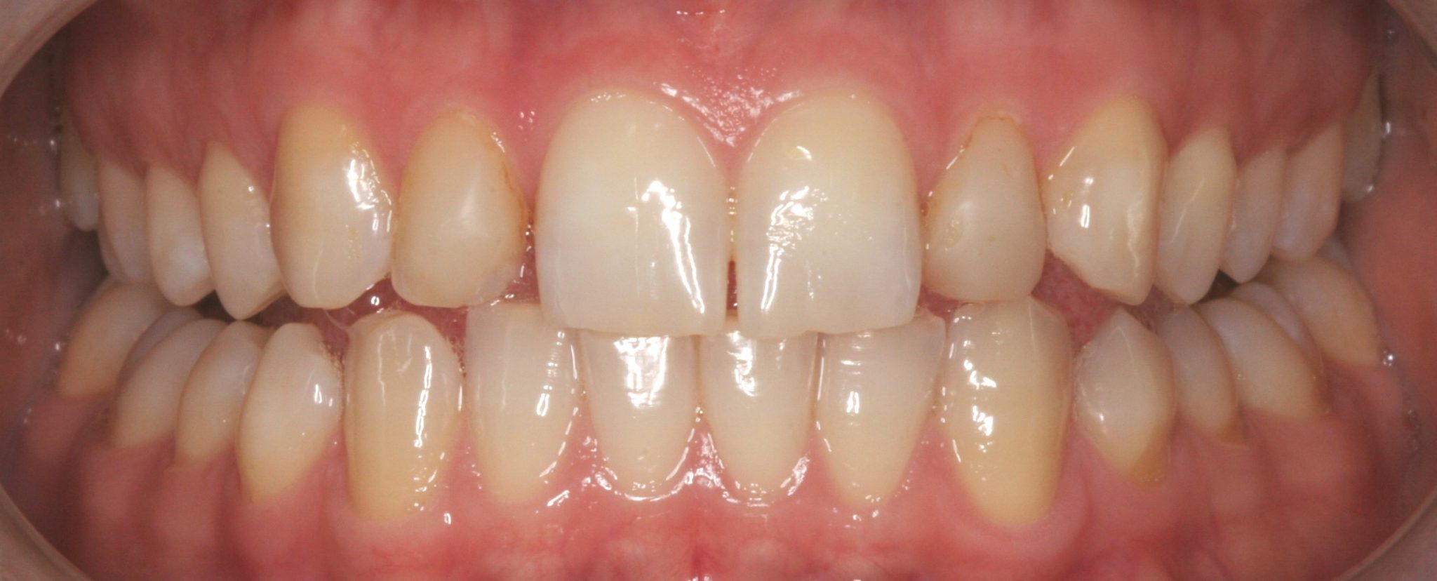 Lateral incisors before veneers were placed