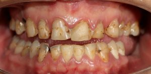 Discoloured teeth before