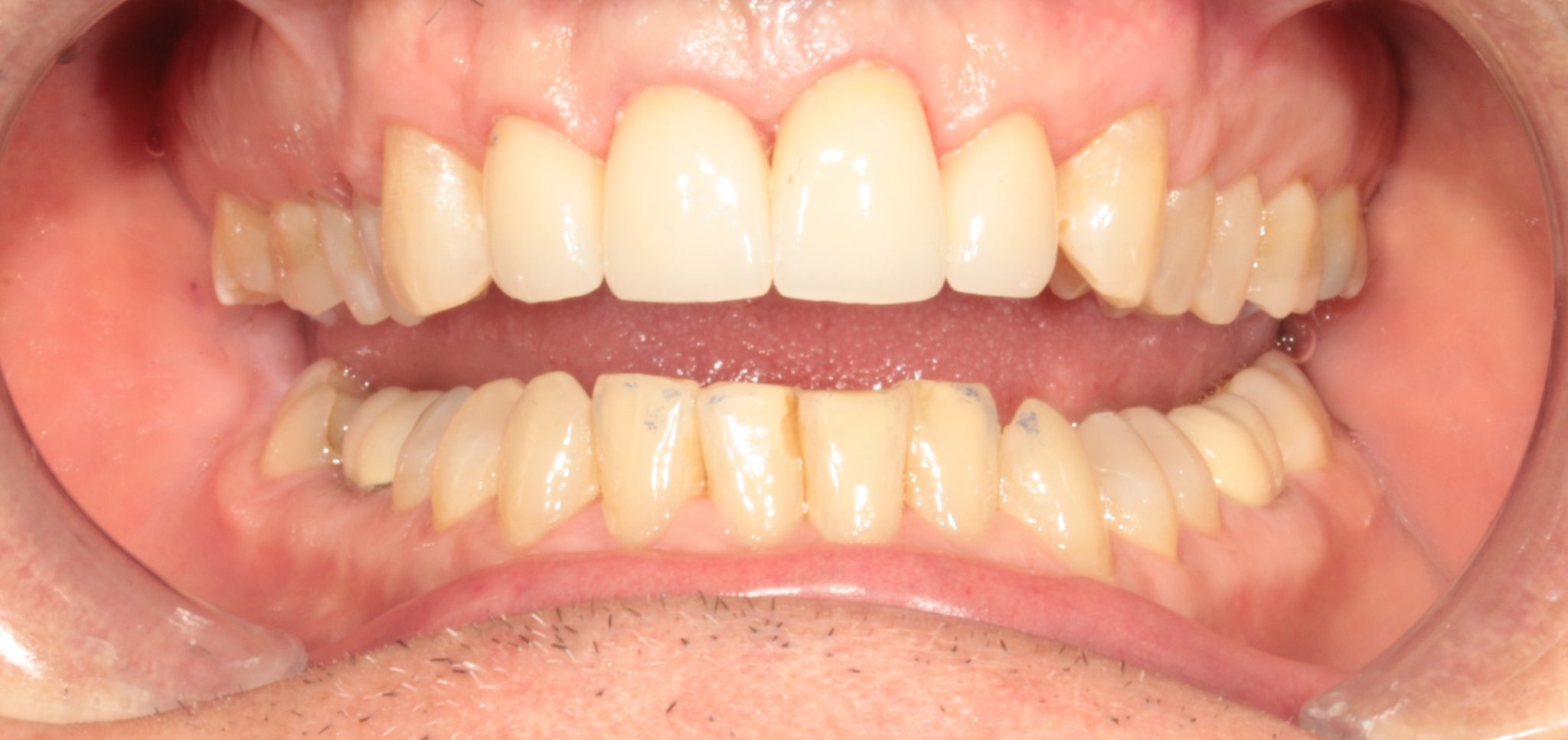 Worn front teeth, after ideal restoration