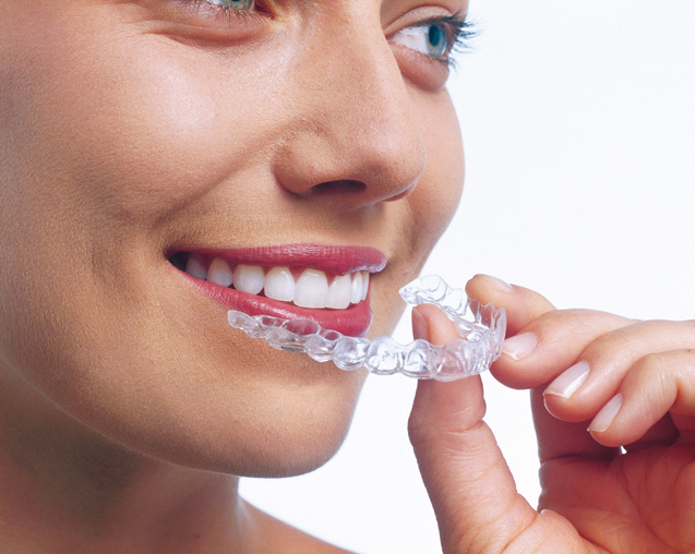Inserting an Invisalign clear aligner